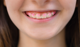 If you have a child with braces, you may want to know if there are ways to get them off faster. Read this article for tips that may reduce the amount of time your child has to wear them.