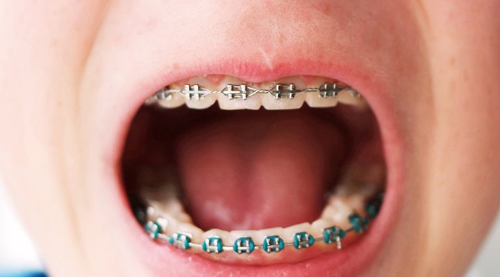 Whether you’re a braces wearer of the past or present, you’ve likely thought those words—if not uttered them out loud. However far-fetched it seems, loose or moving teeth are absolutely normal for those in braces, and often the entire point of having them in the first place.