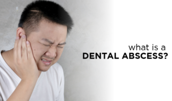 A dental abscess is a pocket of pus that is triggered by a bacterial infection. Learn more about what a dental abscess is, the symptoms of a dental abscess, what causes a dental abscess, prevention methods, and how to treat a dental abscess.