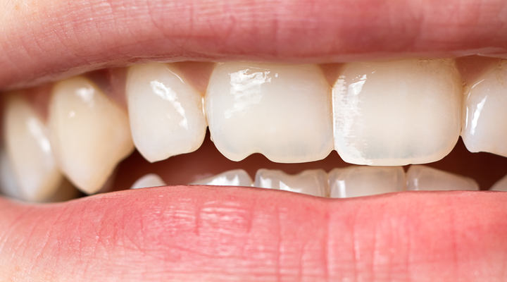 Person smiling with white spots on their teeth.