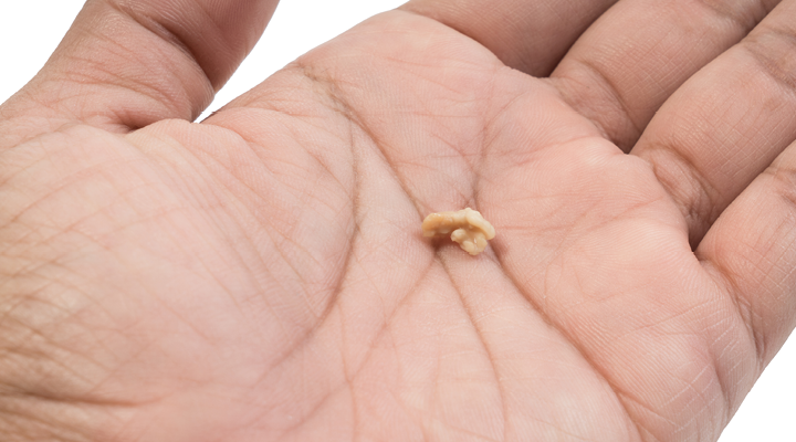 How To Get Rid of Tonsil Stones