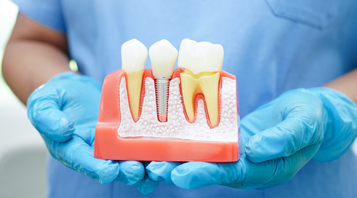 What Are Dental Implants? 