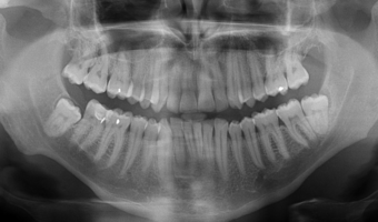 X-ray of a persons mouth.